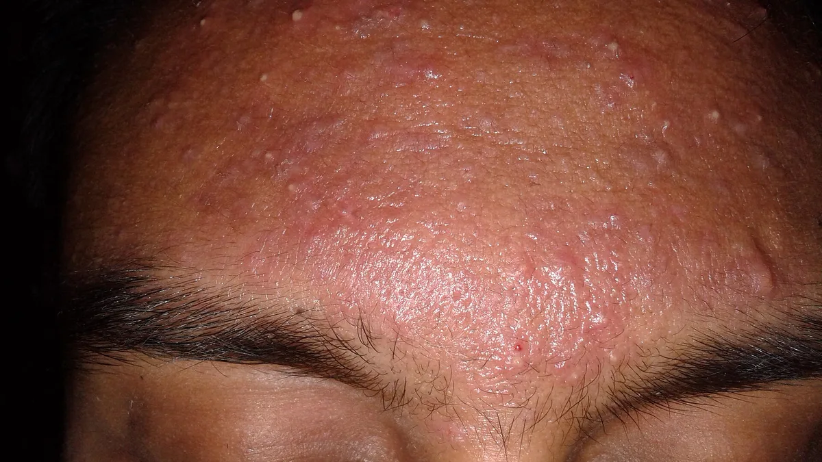 Acne Vulgaris